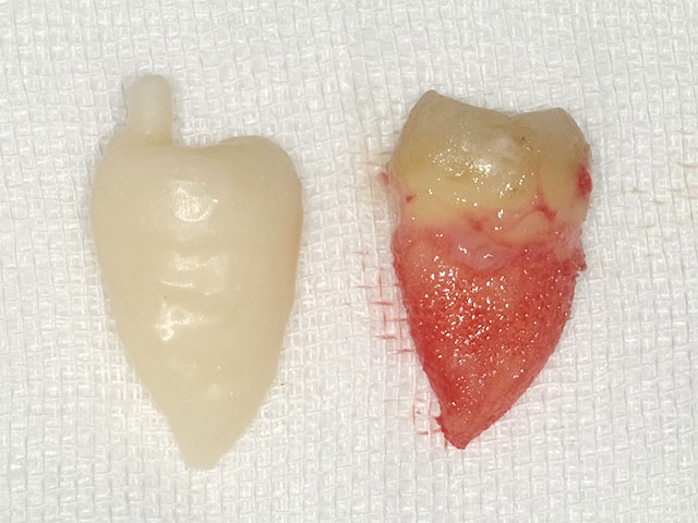 歯の移植治療について
