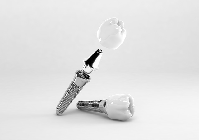 インプラントイメージ