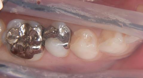 コーティング①