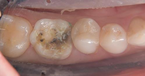 コーティング②