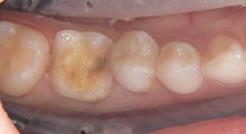 コーティング③