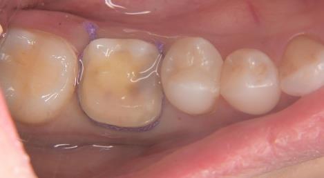 歯肉圧排下での正確な型取り