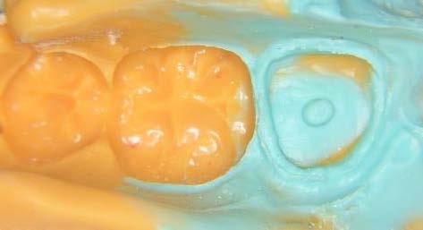 歯肉圧排下での正確な型取り