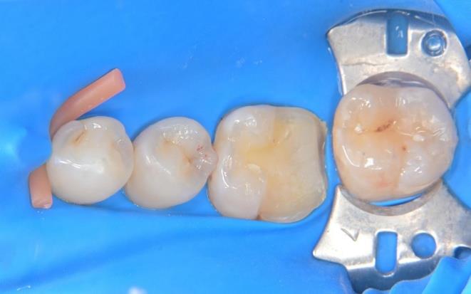 セラミックの装着作業