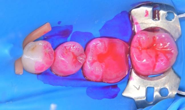 セラミックの装着作業