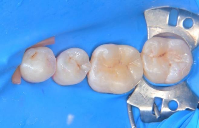 セラミックの装着作業