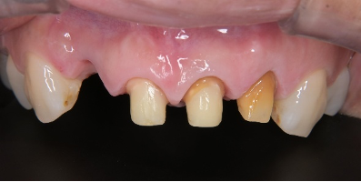 仮歯調整後