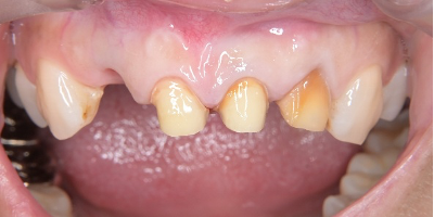 仮歯調整前