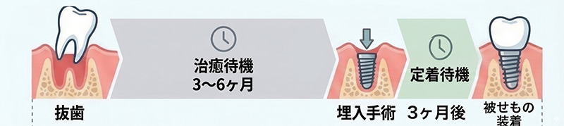 通常のインプラント治療