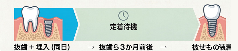 抜歯即時埋入