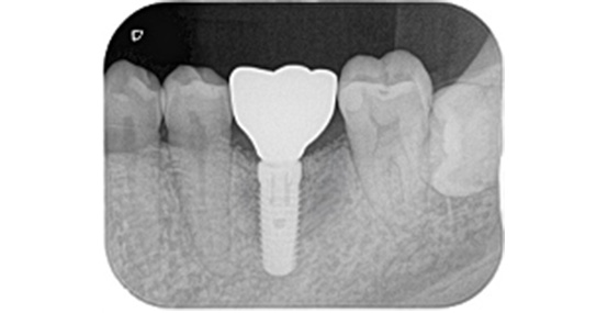 装着後の状態のレントゲン写真