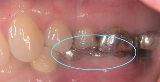 術前の口腔内写真