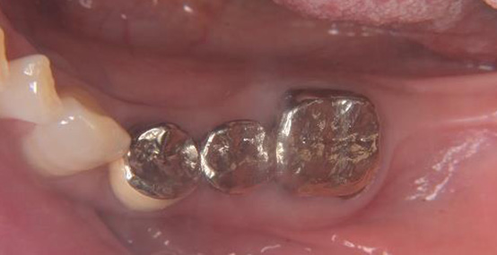 術前の口腔内写真