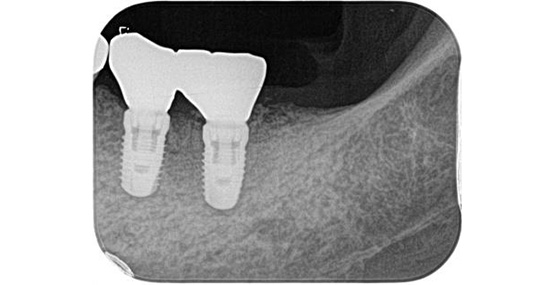 上部構造装着後3