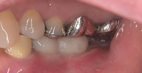 上部構造装着後1