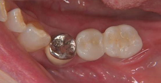 上部構造装着後2