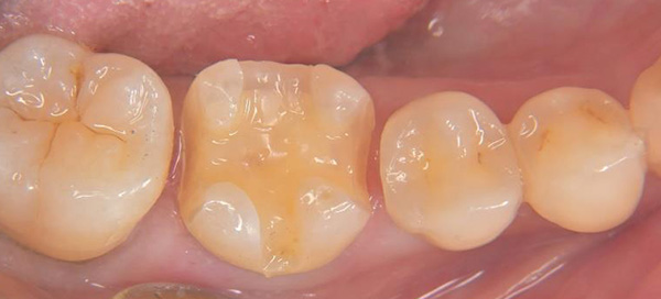 型取り前の状態