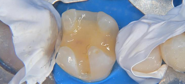 型取り前の状態