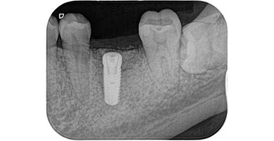 一次手術後のレントゲン写真
