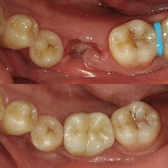 今回も前回に引き続き歯牙移植の投稿です😊

前回の症例とは別の症例ですが、縁下カリエスで抜歯となった左下6番に対し、左下8番を移植しました👍

この方は重度の金属アレルギーということで、メタルクラウンや保険の義歯はできない状況でした。

その中で患者さんと相談した結果自家歯牙移植を行うことになりました！

インプラントもすごく魅力的な治療ですし、私自身行っておりますが、ご自身の歯を移植することで元のように咬めるようになる自家歯牙移植も負けず劣らず素敵な治療と思い、適応症であればご提案させて頂いてます👍

移植時に使用したレプリカについても今後投稿させて頂きます。

最後までご覧いただきありがとうございました🙇‍♂️
ご不明な点等あればお気軽にご相談ください！

#楓の森歯科クリニック 
#自家歯牙移植術 
#歯牙移植 
#3dプリンター 
#合志市歯医者 
#合志歯科医院 
#御代志歯医者
#ジルコニアクラウン 
#ご自身の歯でずっと食べたい方へ 
#金属アレルギー 
#メタルフリー